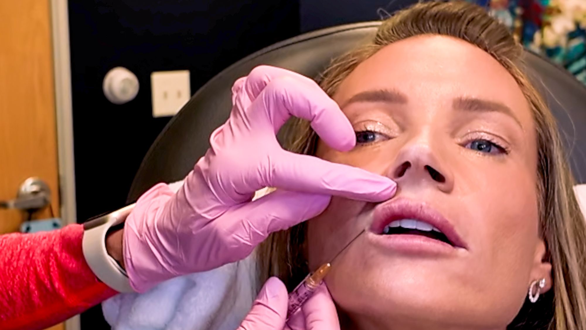 Restylane Kysse Lip Filler: Why the Cannula Method is a Game Changer! - treatment image