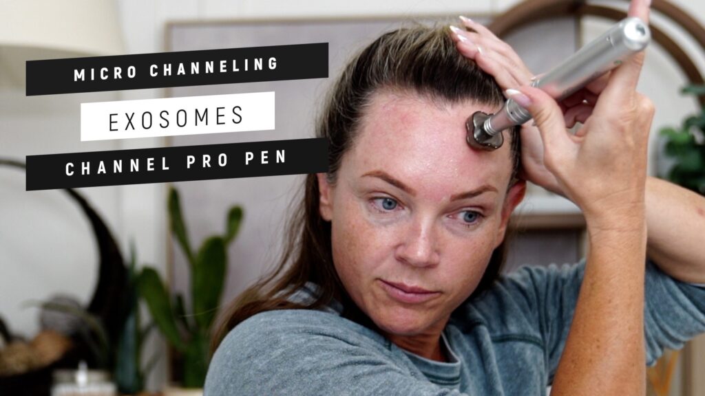 Can Microneedling With Exosomes Erase Wrinkles?