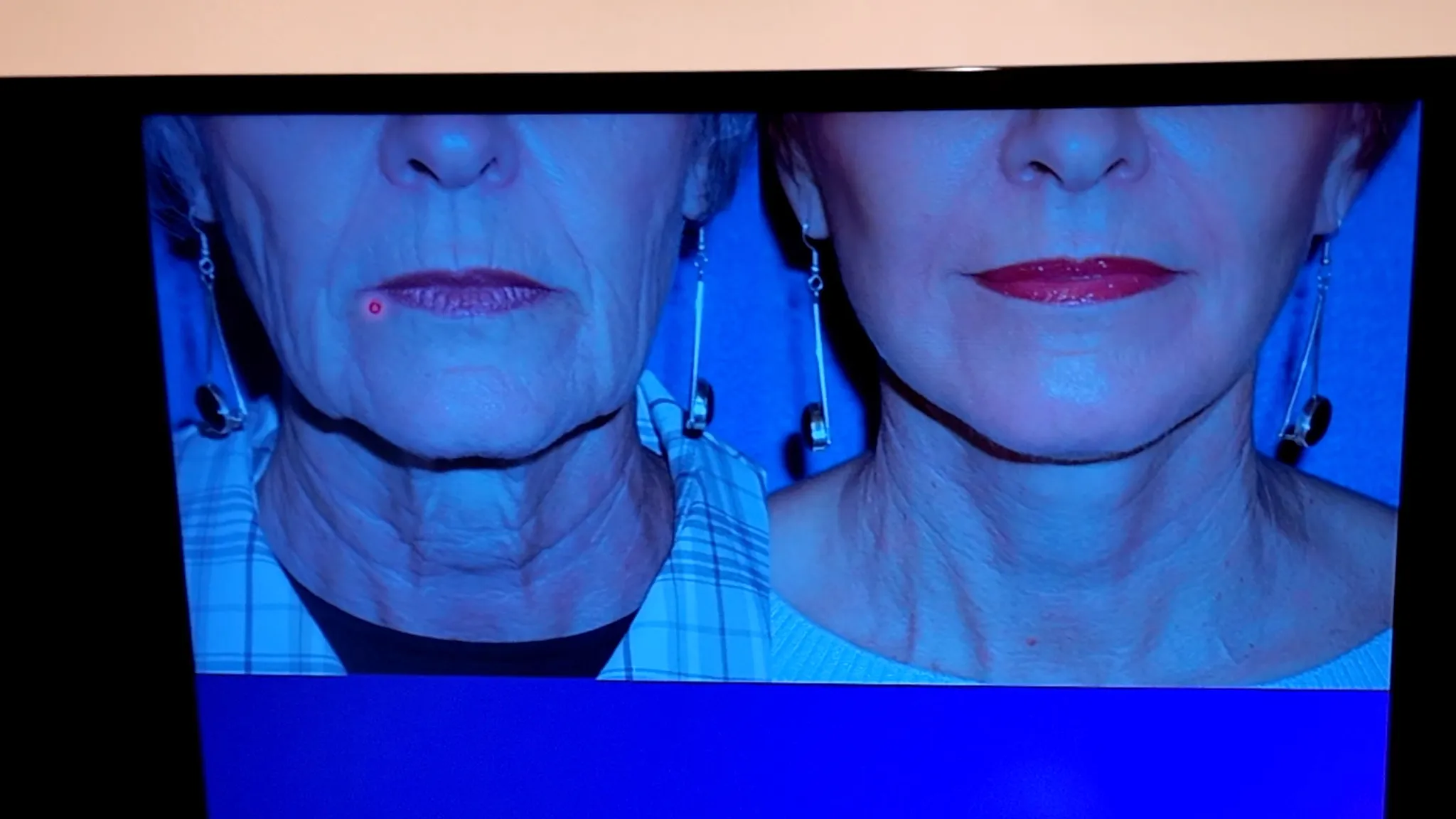 Do I Need a Facelift? Join Me for My Consultation Experience & Cost! - treatment image