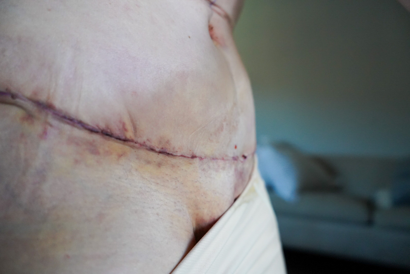 TUMMY TUCK POST OP NATURAL KAOS - treatment image