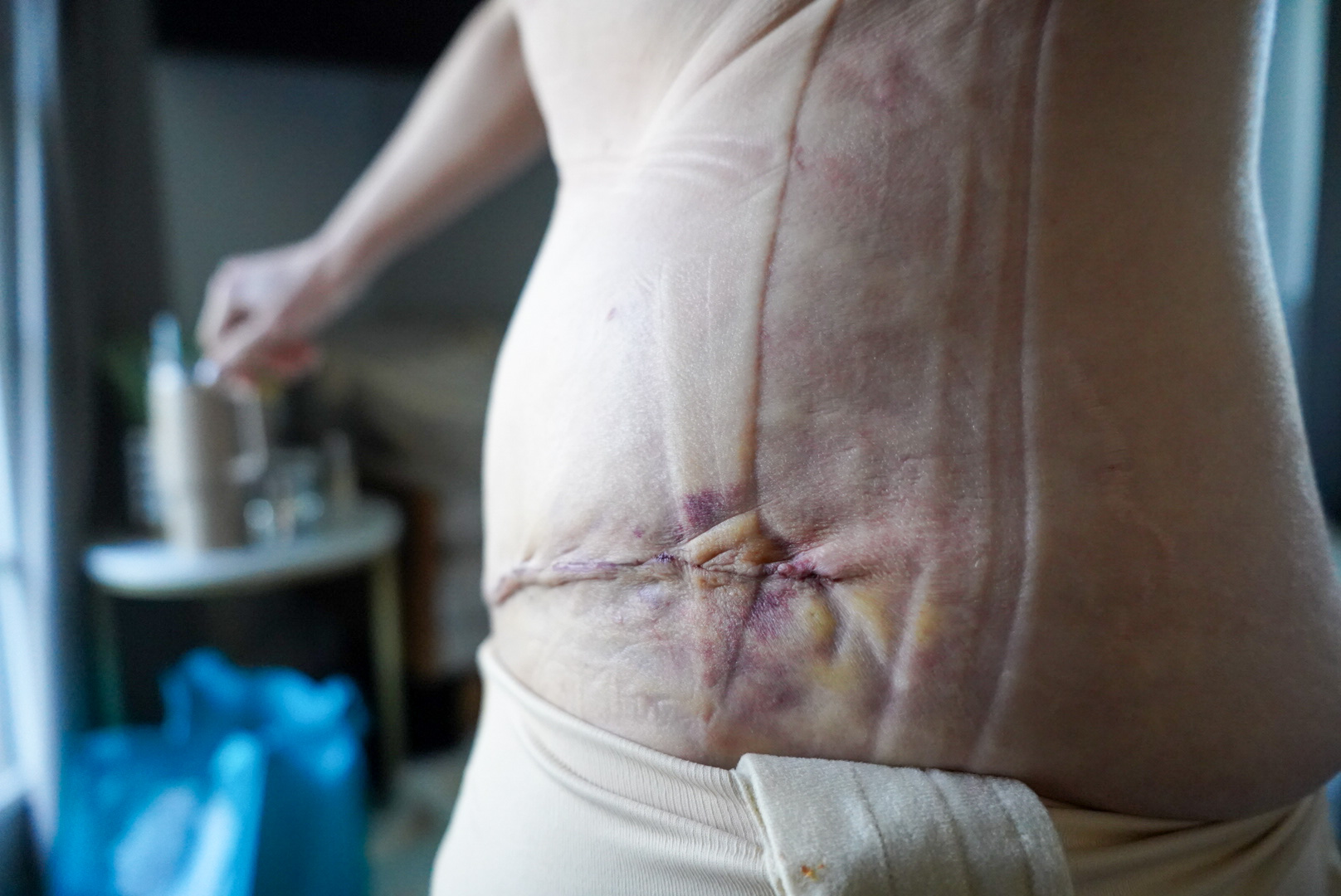 TUMMY TUCK POST OP NATURAL KAOS - treatment image