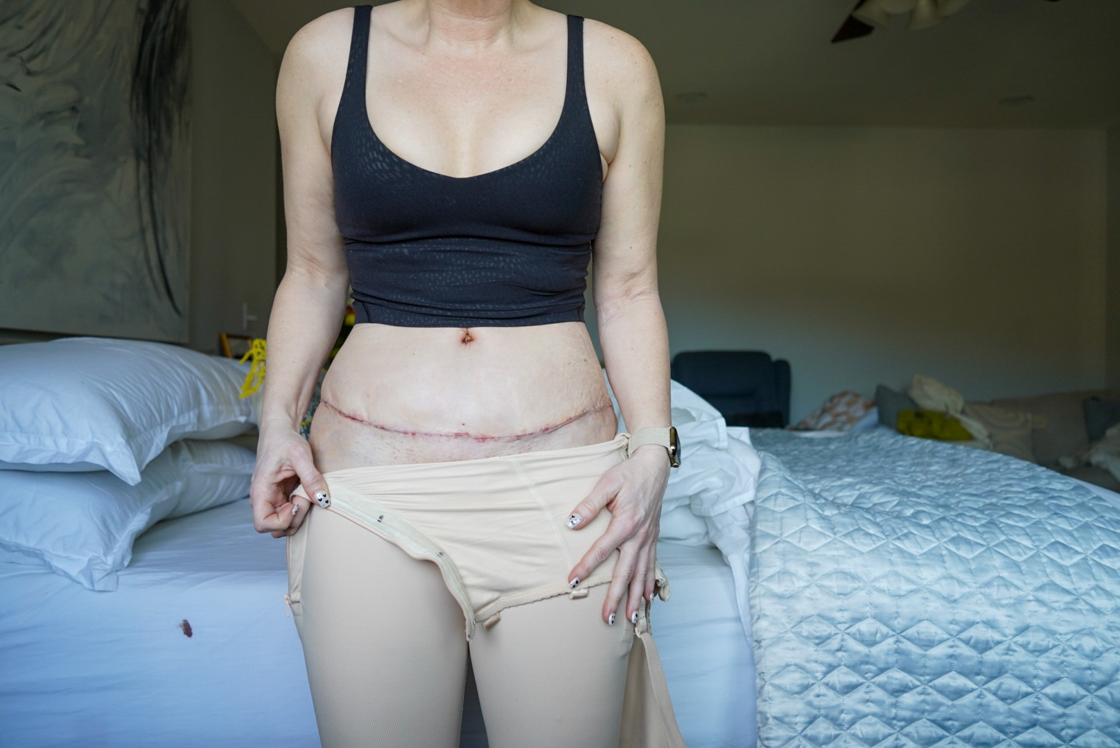 TUMMY TUCK POST OP NATURAL KAOS - treatment image