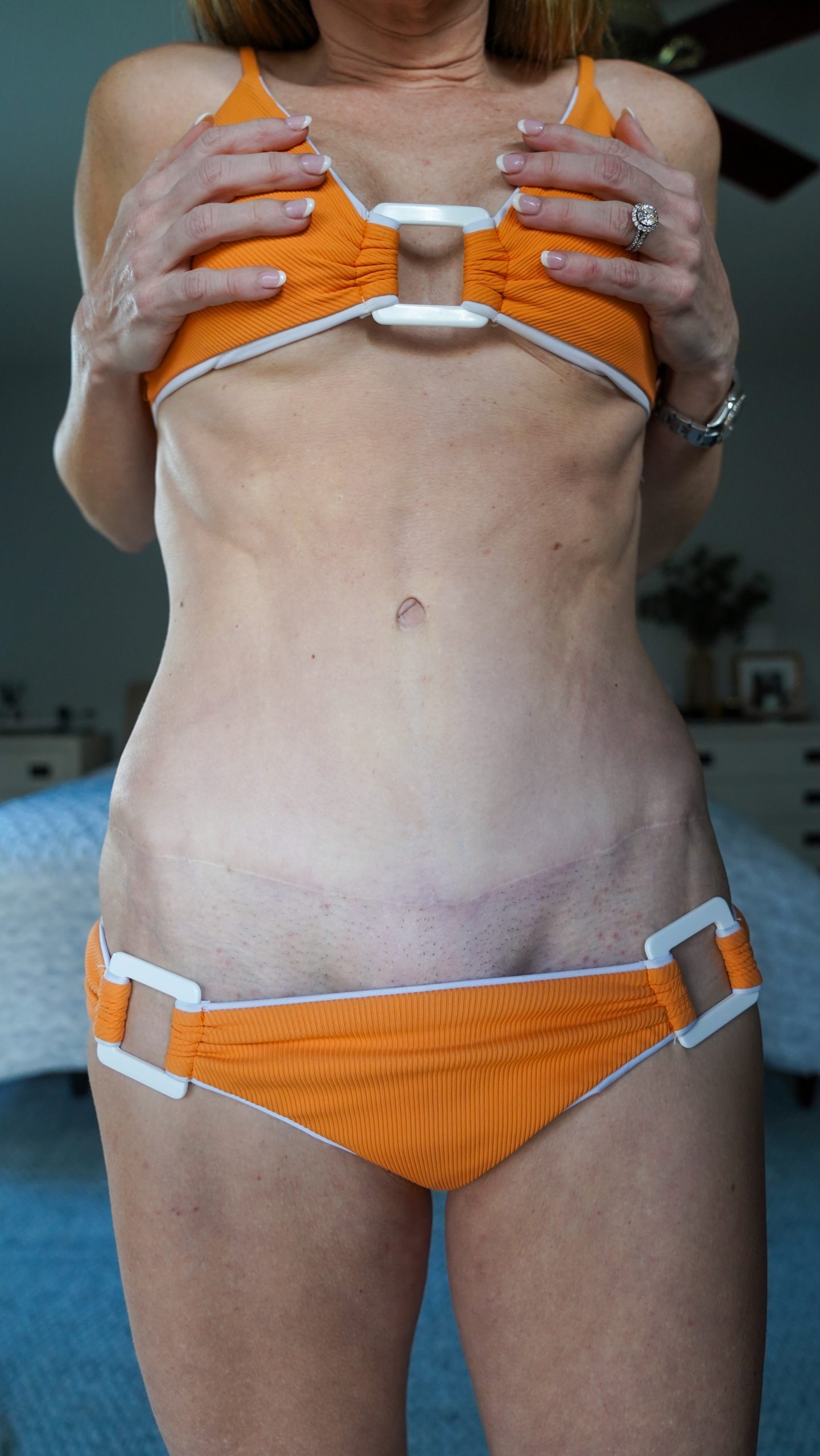 Tummy Tuck Before and After SCAR Check - treatment image