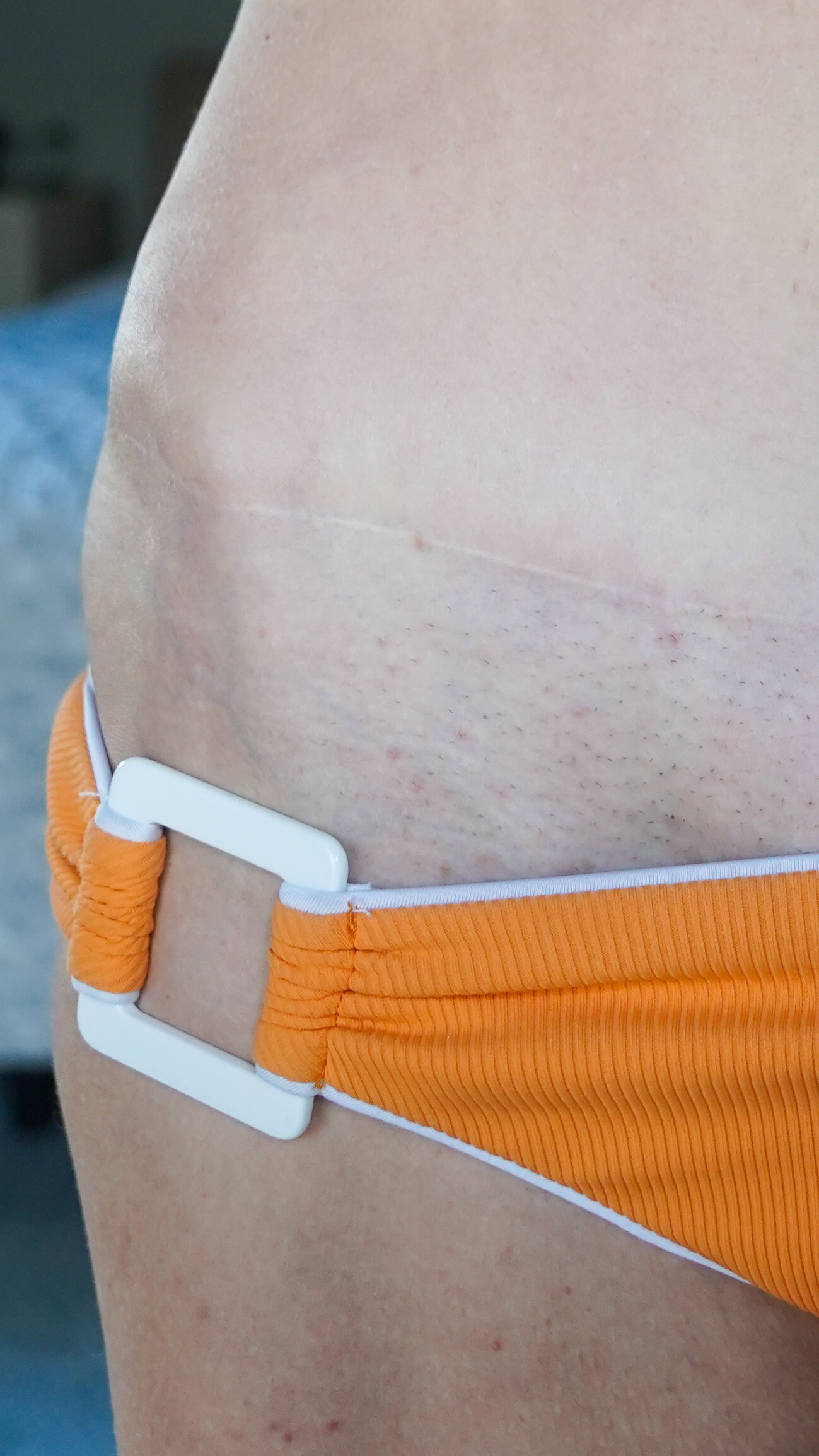 Tummy Tuck Before and After SCAR Check - treatment image