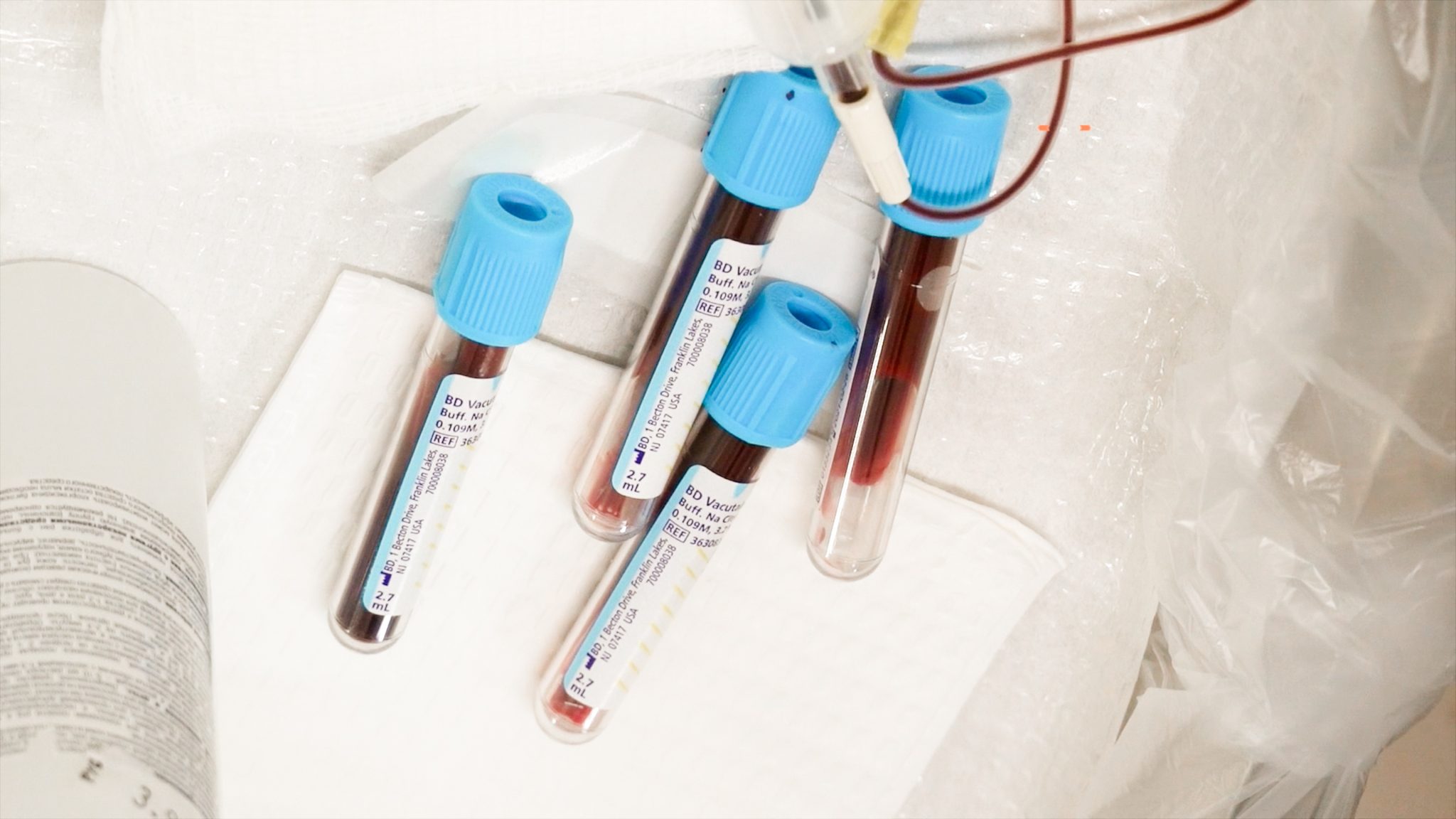 Can you get HIV from a Vampire Facial? Are PRP Injections safe? - treatment image