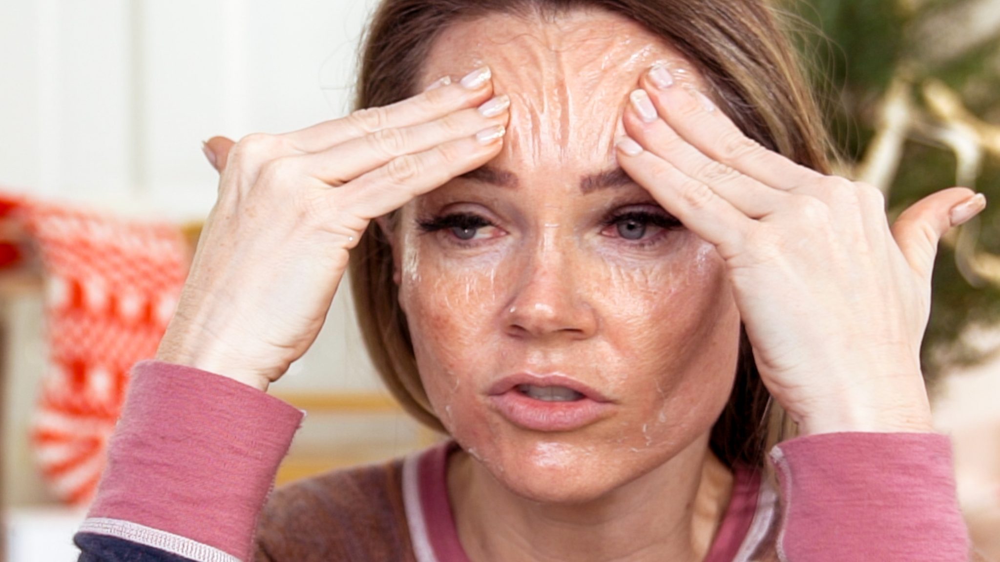 30% TCA PEEL PART 2 – HEALING