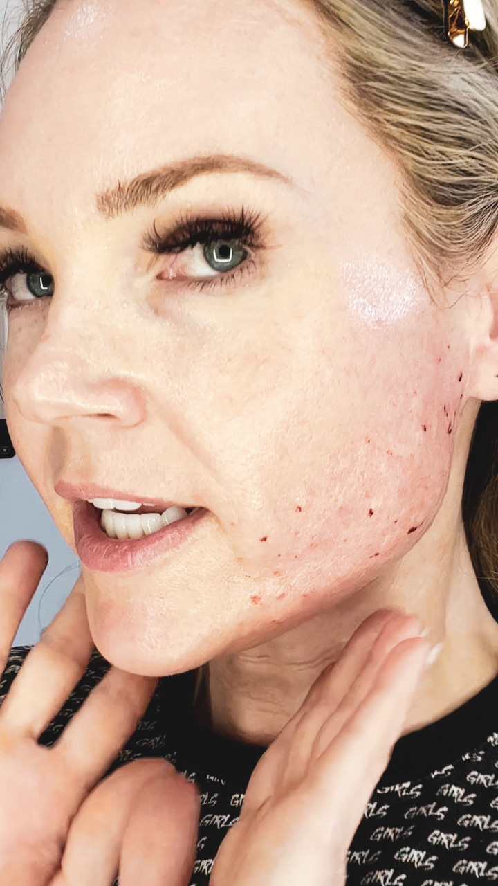 Side Face Profile Skincare Treatments - treatment image
