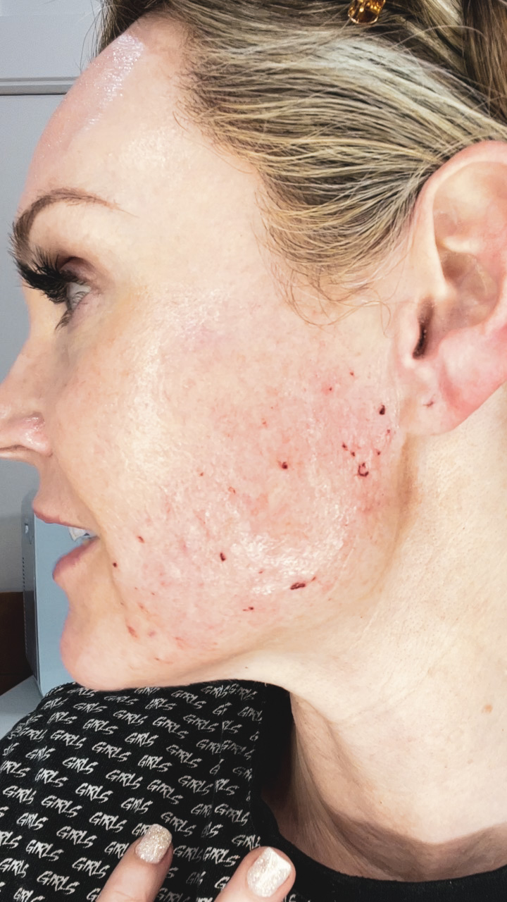 Side Face Profile Skincare Treatments - treatment image