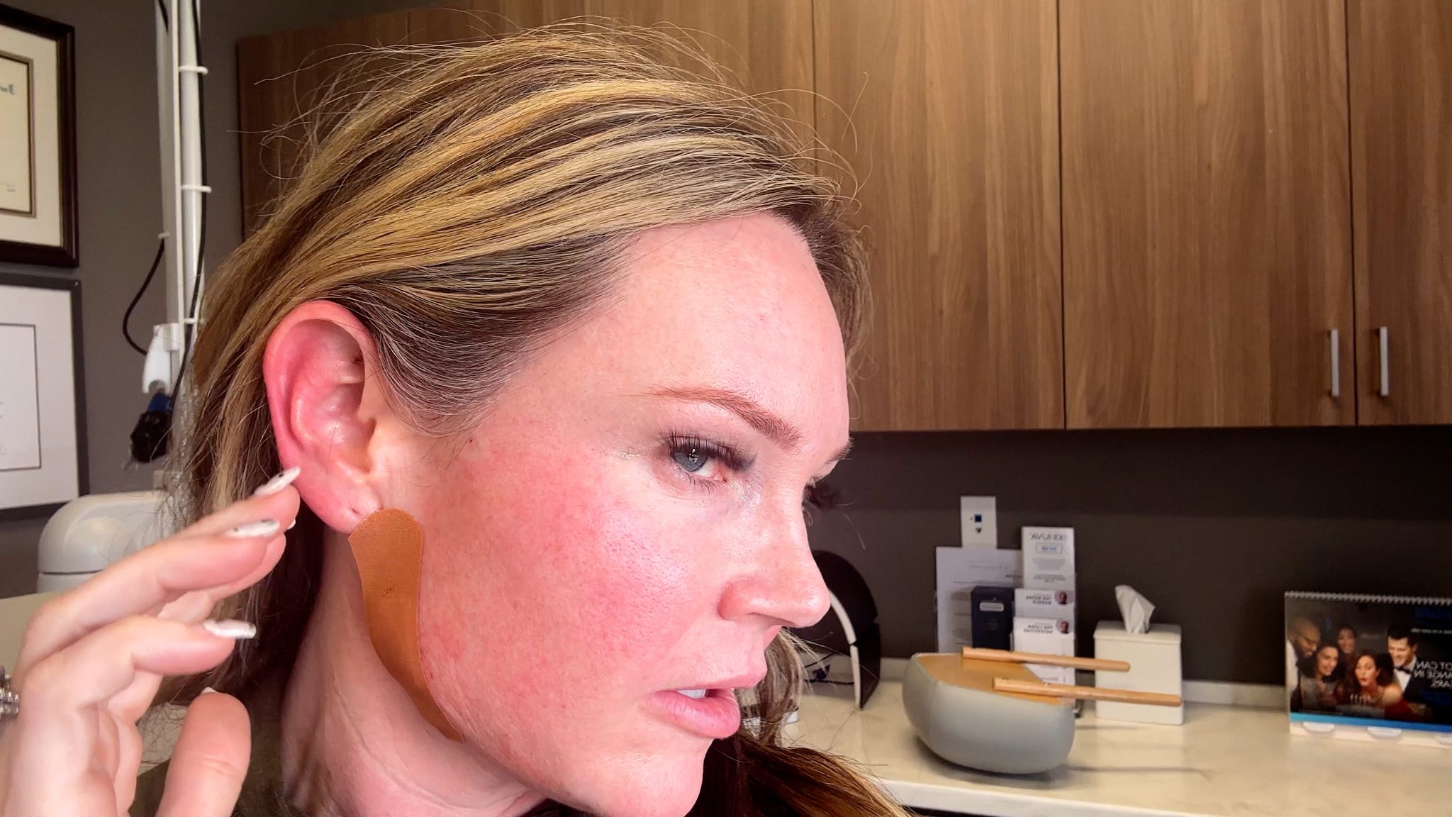 SCULPTRA 1 YEAR AFTER 4 VIALS COMPARISON - treatment image