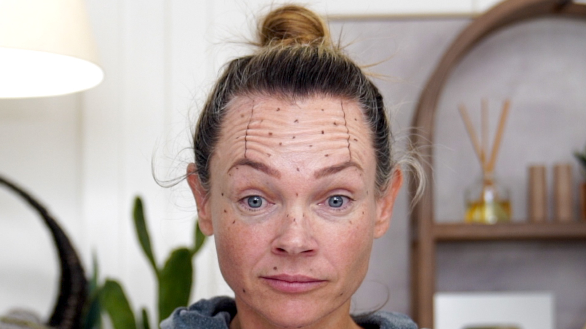 Transform Your Ozempic Face With Innotox And PLLA - treatment image