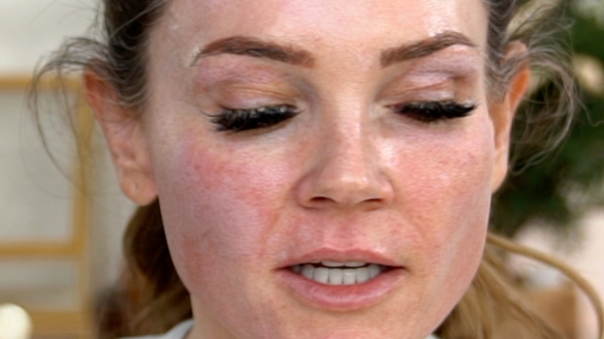 30% TCA PEEL PART 1 – APPLICATION - treatment image