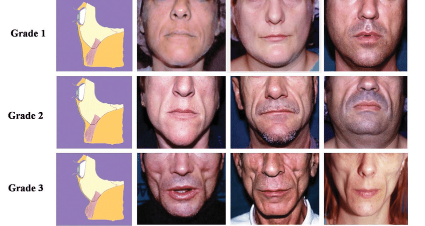 SCULPTRA 1 YEAR AFTER 4 VIALS COMPARISON - treatment image