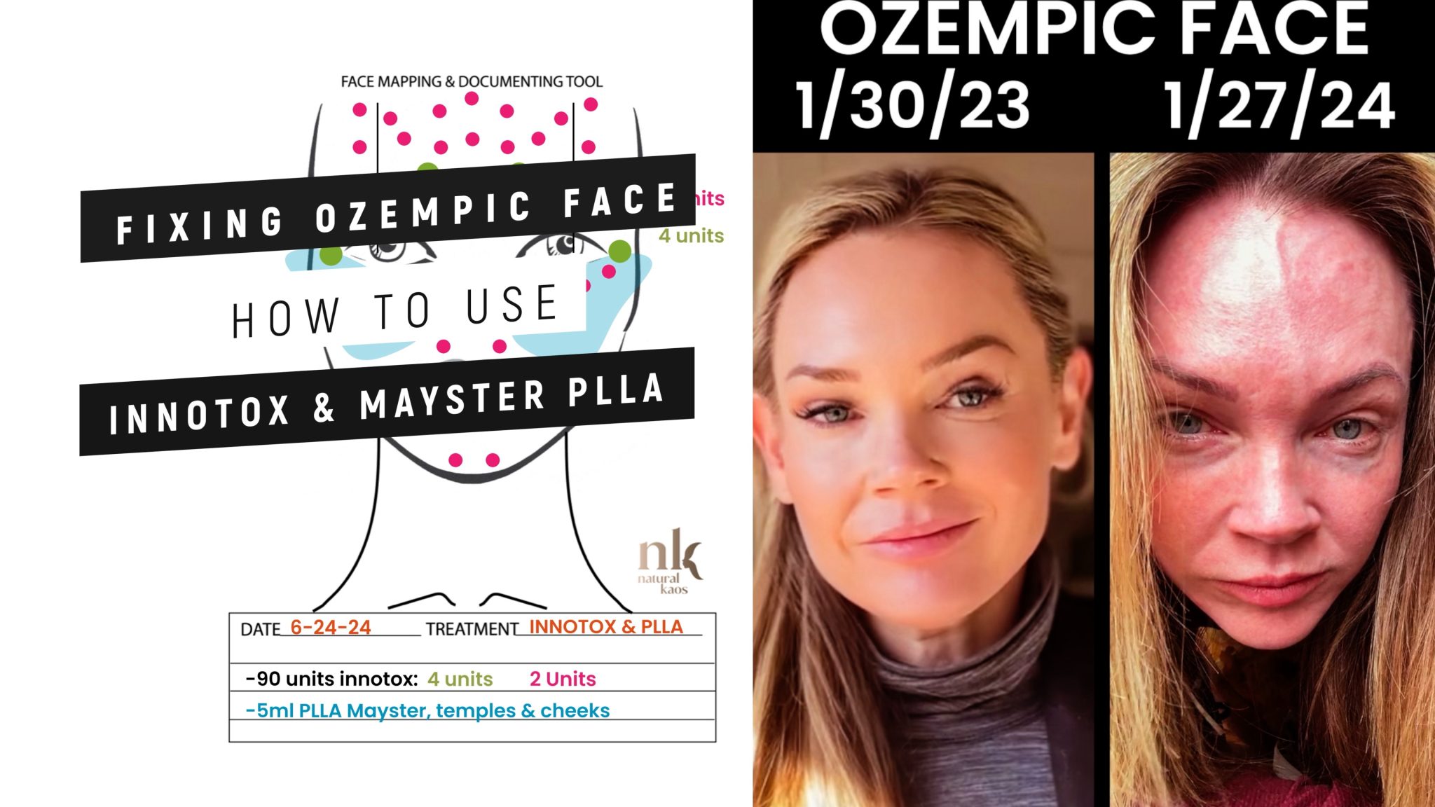 Transform Your Ozempic Face With Innotox And PLLA