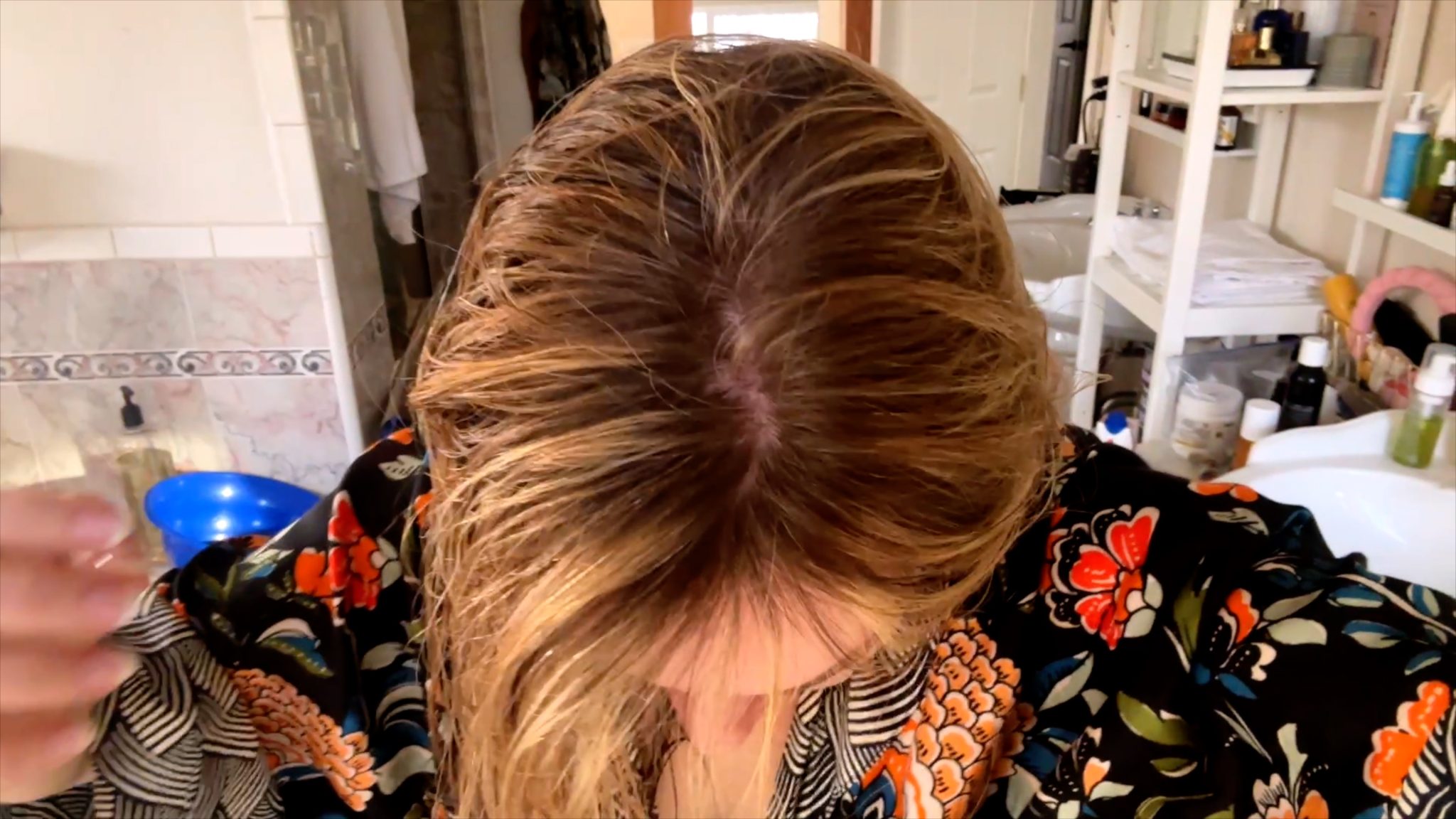 Ozempic weight loss before and after vs Gastric Sleeve: Did Semiglutide Ruin My Hair? - treatment image