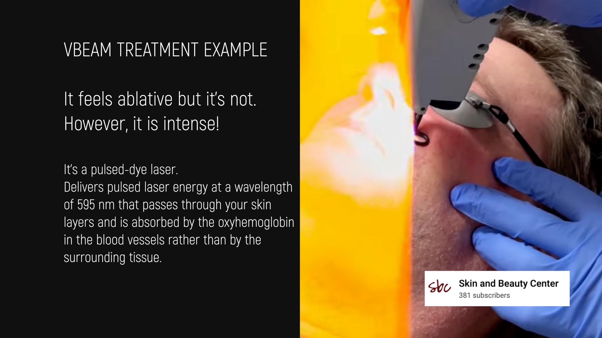 VBEAM LASER BEFORE AND AFTER - treatment image