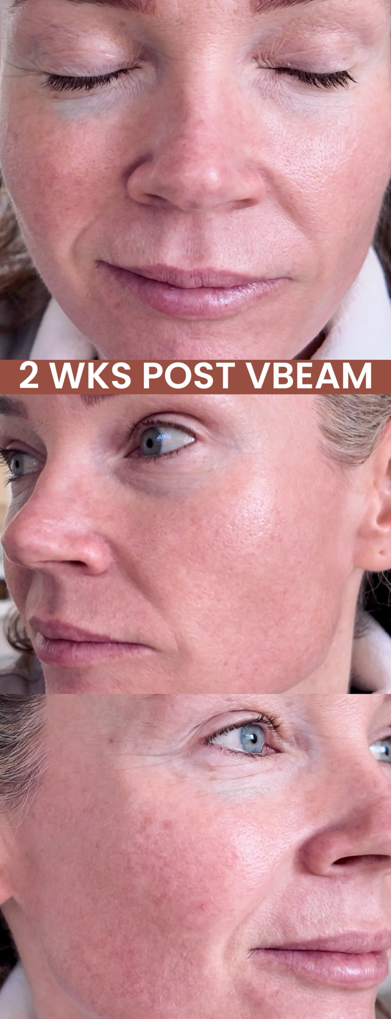 VBEAM LASER BEFORE AND AFTER - treatment image