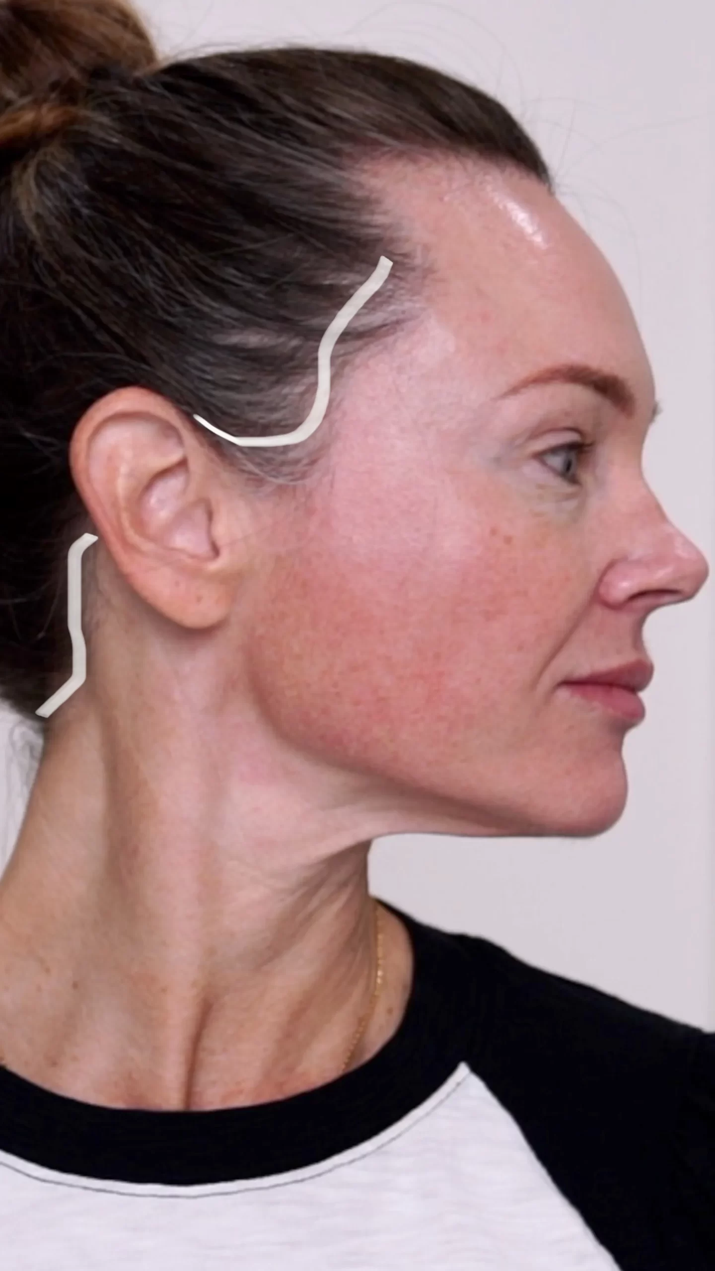 Do I Need a Facelift? Join Me for My Consultation Experience & Cost! - treatment image
