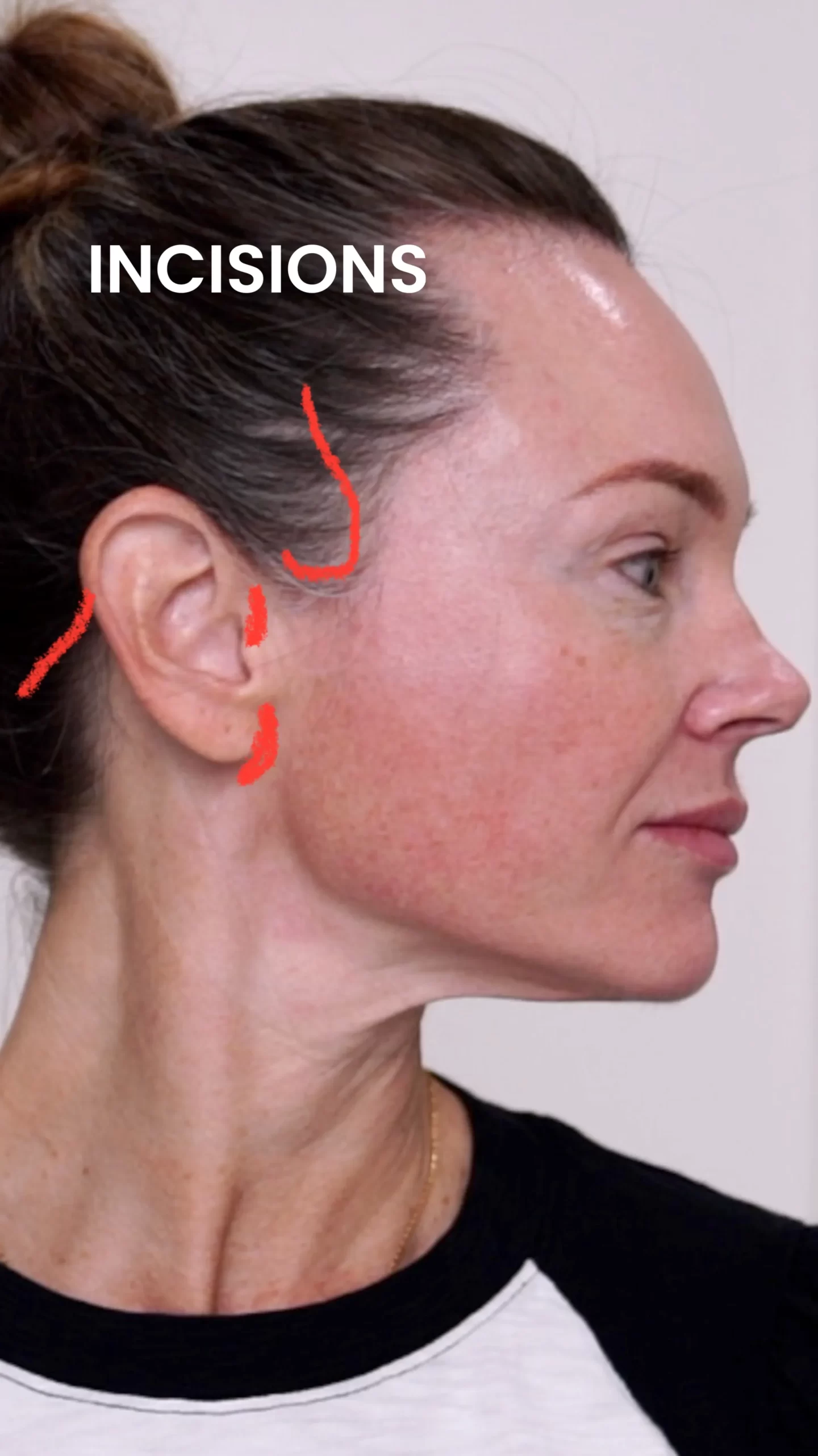 Do I Need a Facelift? Join Me for My Consultation Experience & Cost! - treatment image