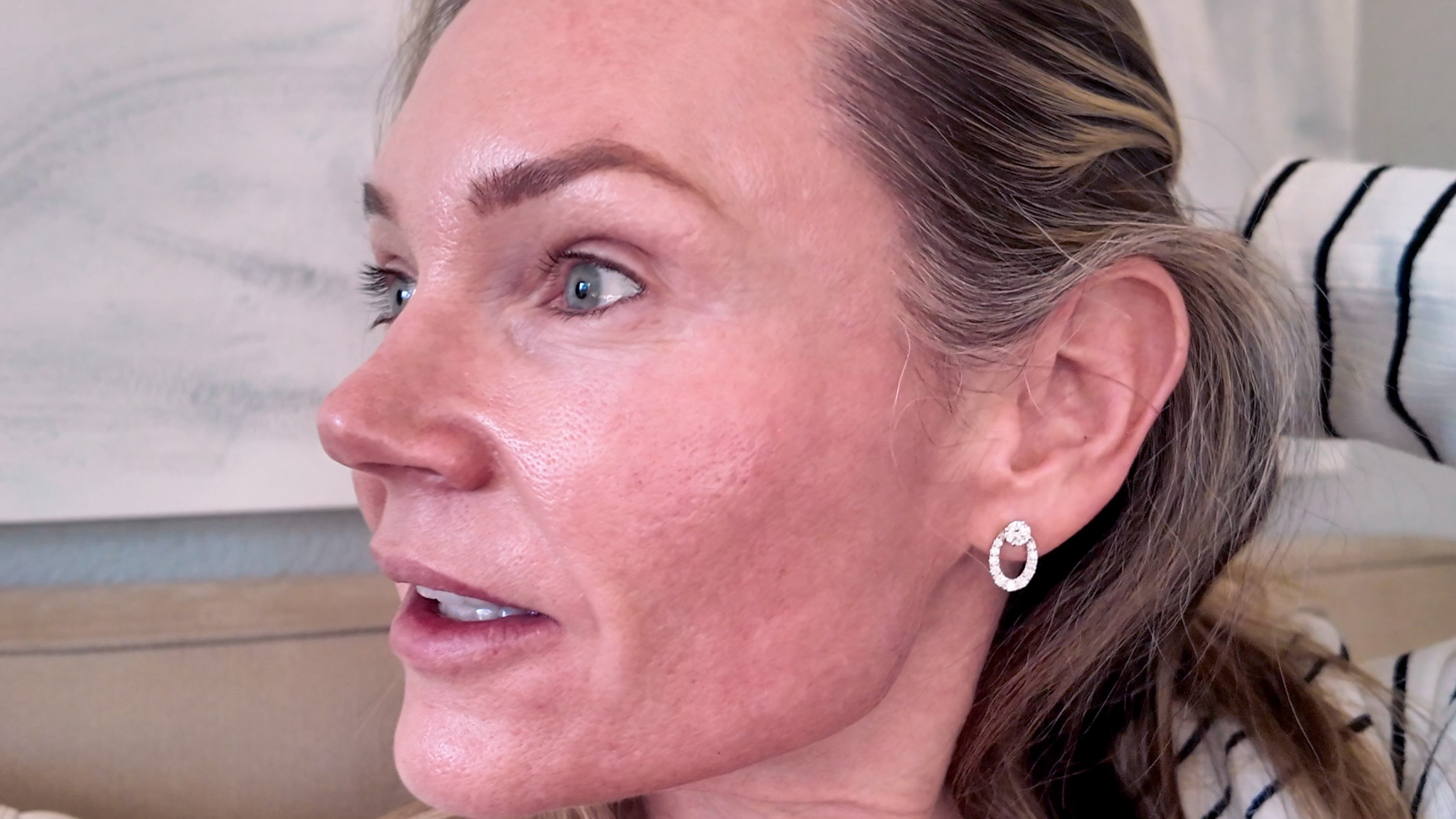 VBEAM LASER BEFORE AND AFTER - treatment image