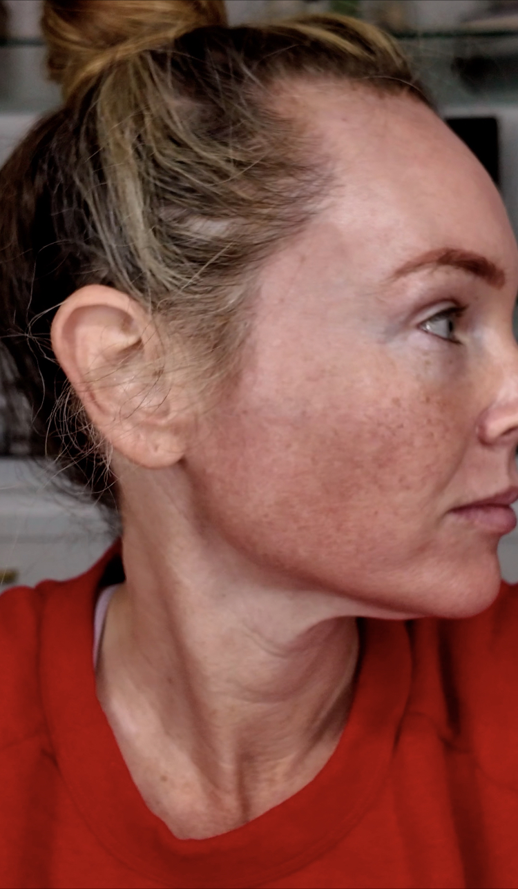 TCA PEEL EVERYTHING YOU NEED TO KNOW - treatment image