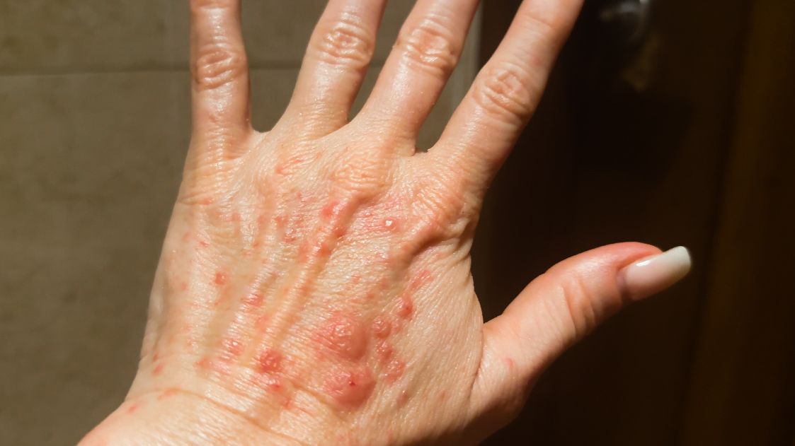 Using Melanotan to Prevent Polymorphous Light Eruption aka SUN POISONING - treatment image