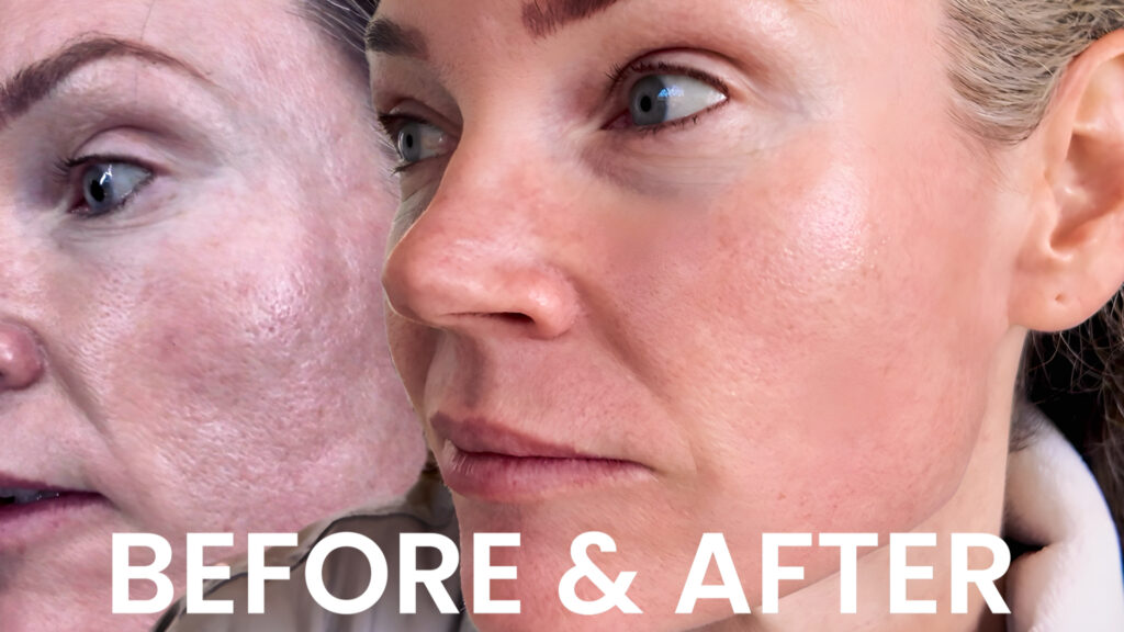 VBEAM LASER BEFORE AND AFTER