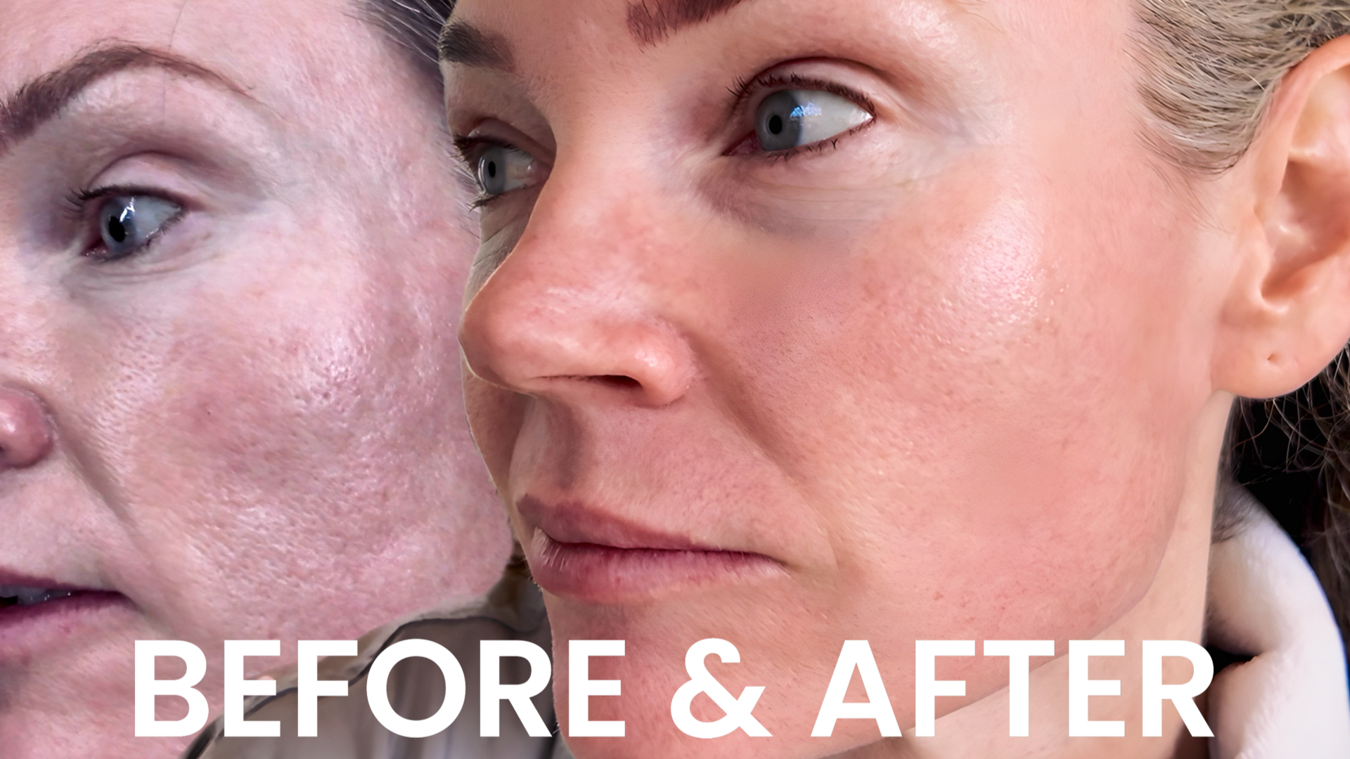 VBEAM LASER BEFORE AND AFTER