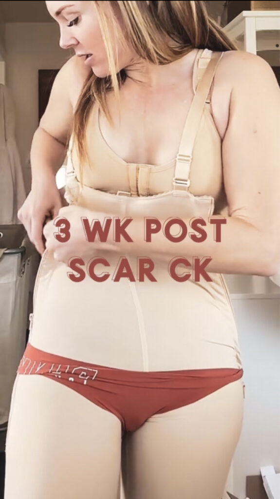 MOMMY MAKEOVER SCARS 3 WEEKS POST OP: What To Expect