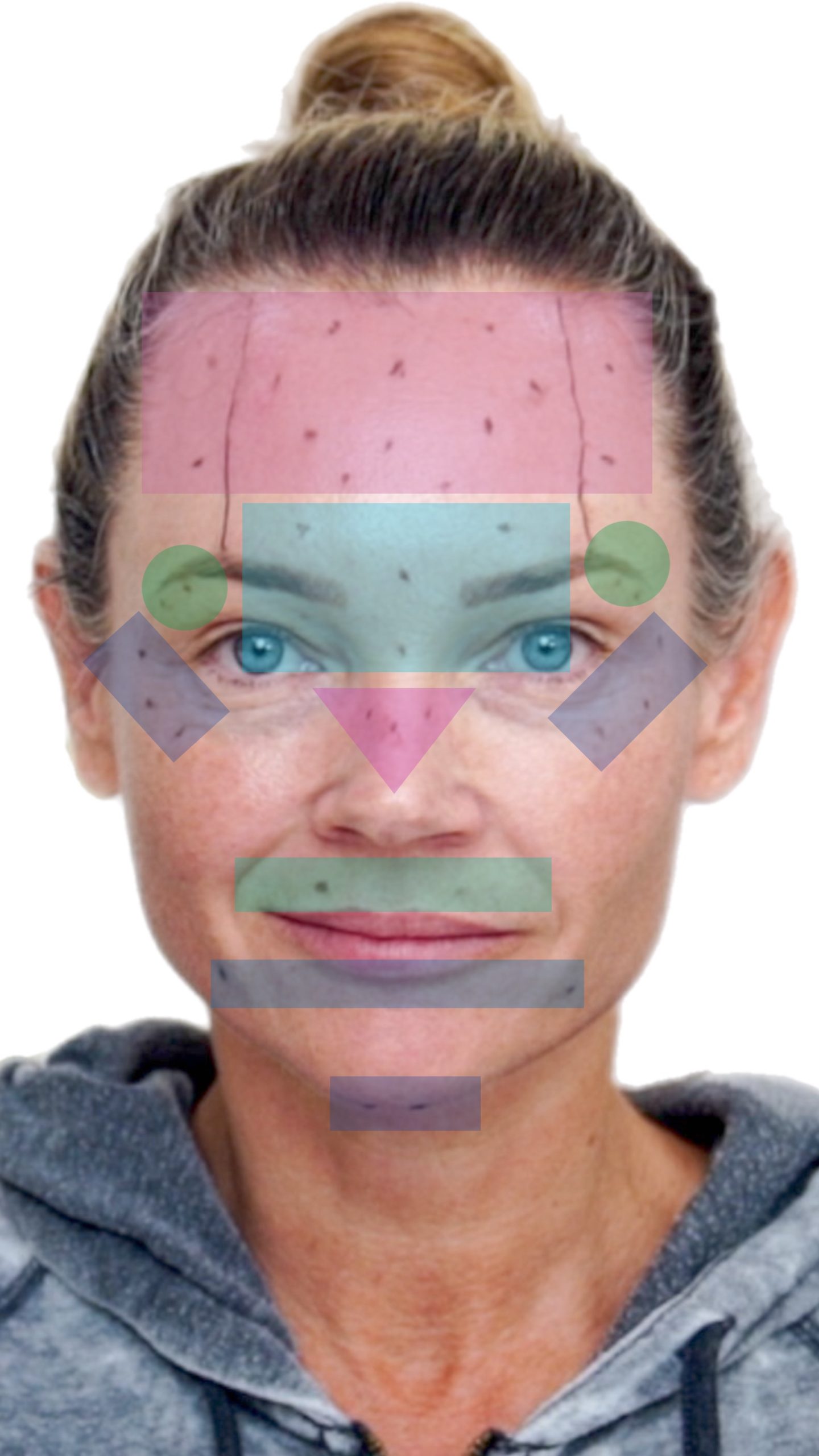 Transform Your Ozempic Face With Innotox And PLLA