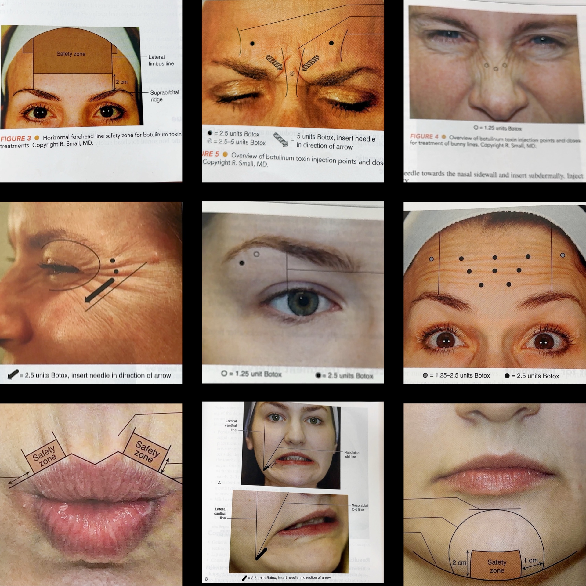 Transform Your Ozempic Face With Innotox And PLLA - treatment image