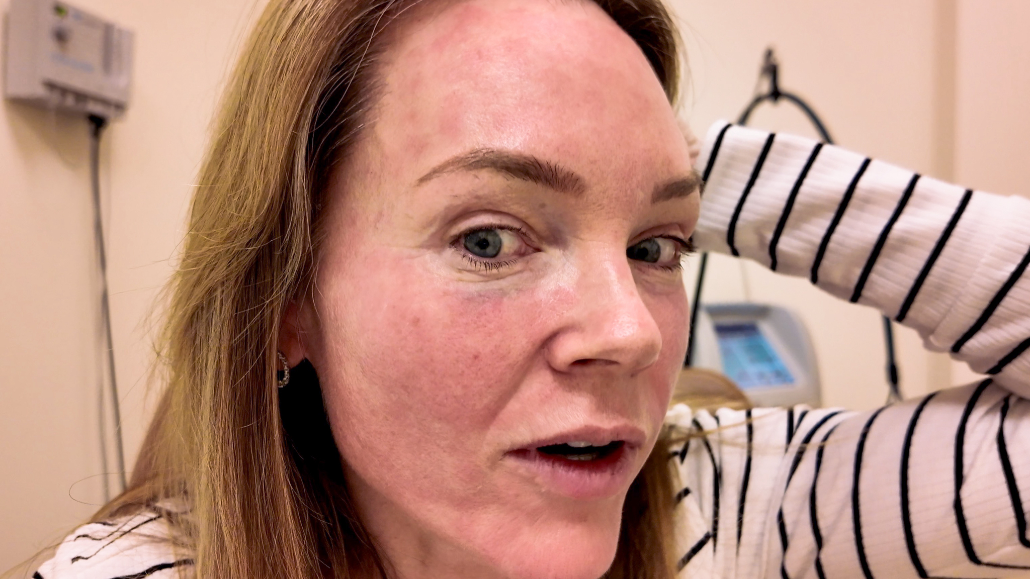 VBEAM LASER BEFORE AND AFTER - treatment image