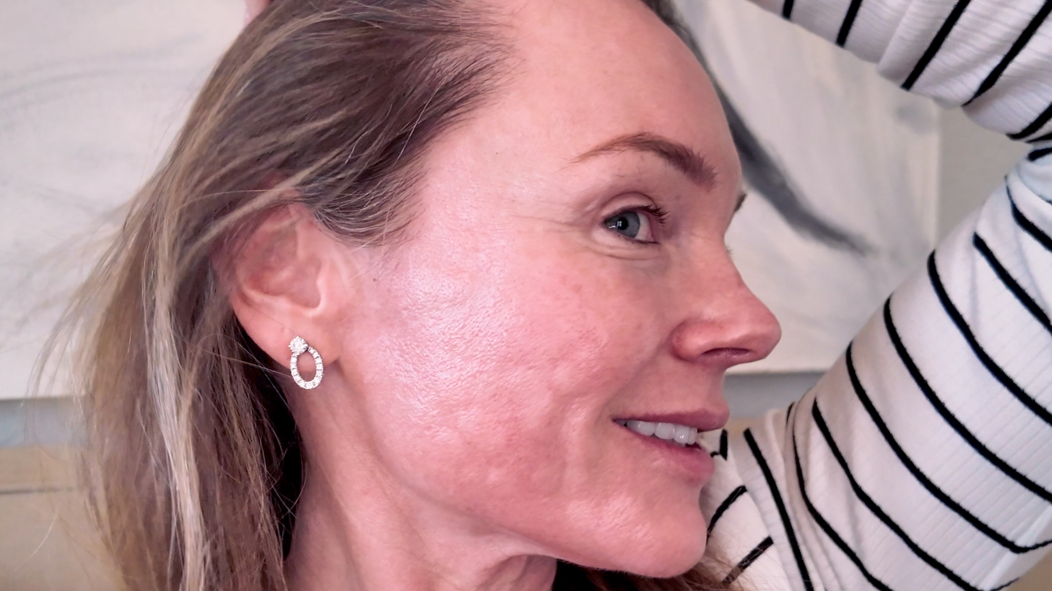 VBEAM LASER BEFORE AND AFTER - treatment image