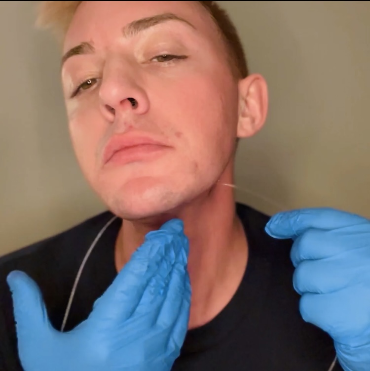 AestheLine Double Arm PLLA THREADS - treatment image