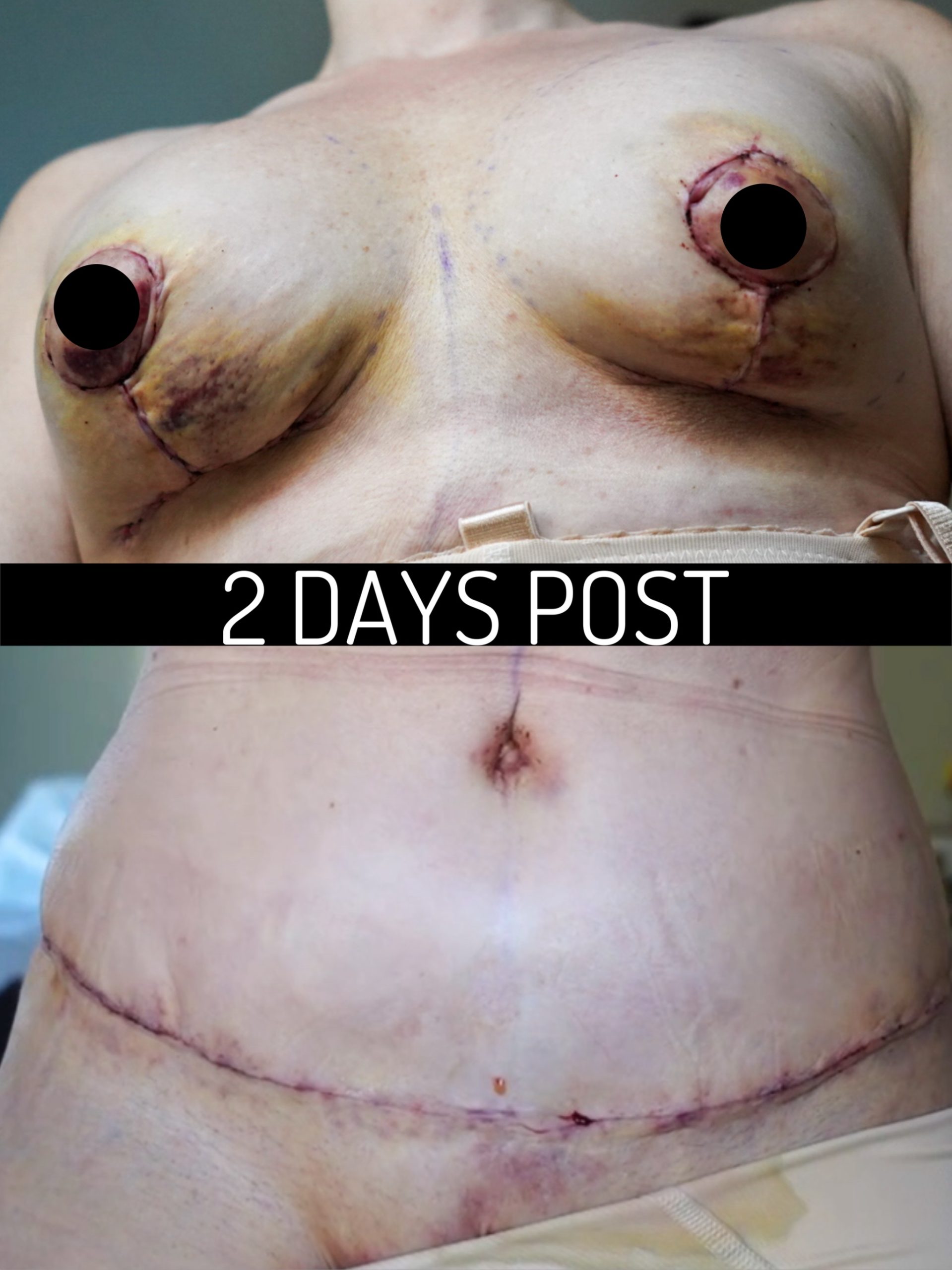 Tummy Tuck Before and After SCAR Check