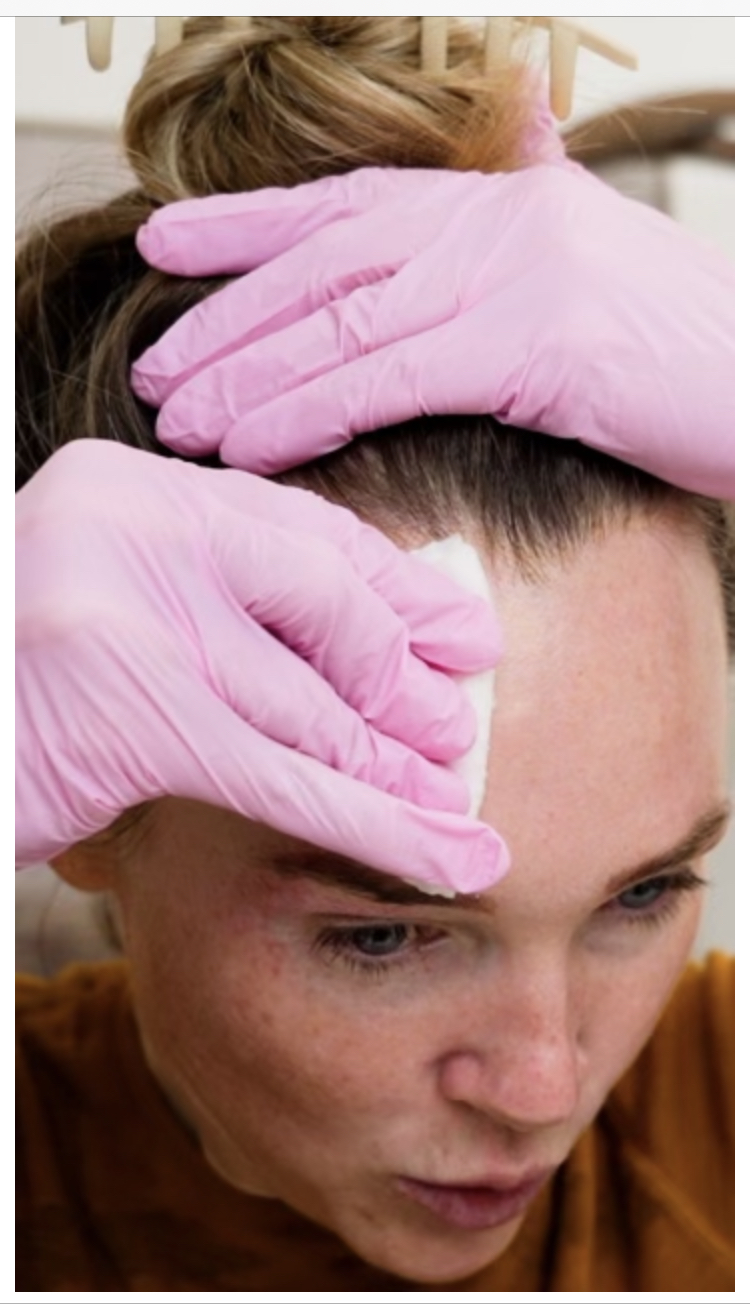 HOW TO DO A 25% TCA PEEL AT HOME | PREP