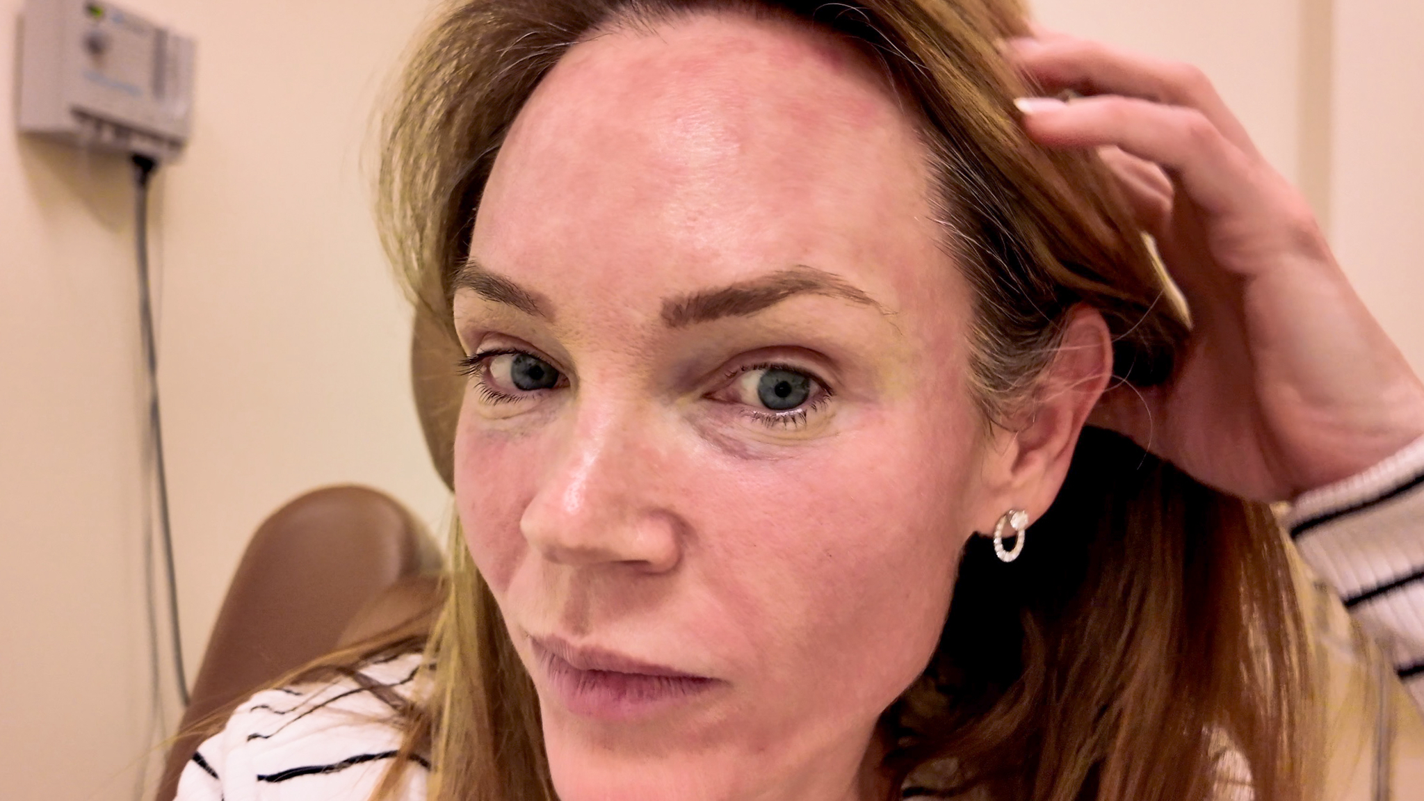 VBEAM LASER BEFORE AND AFTER - treatment image