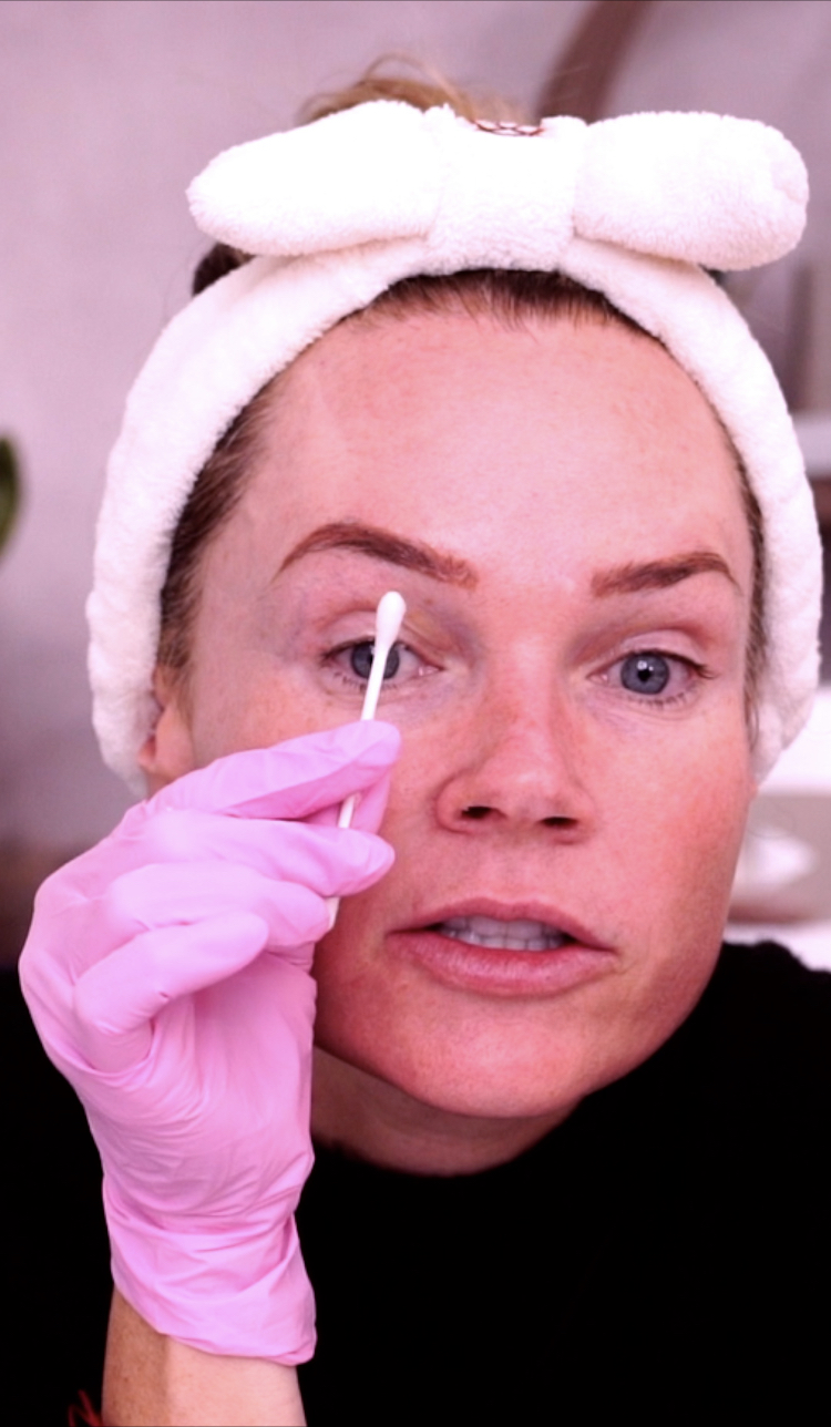 TCA PEEL EVERYTHING YOU NEED TO KNOW - treatment image