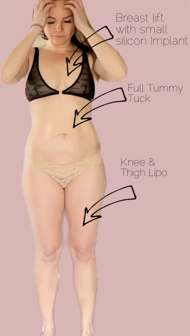 MOMMY MAKEOVER PREPARATION - treatment image