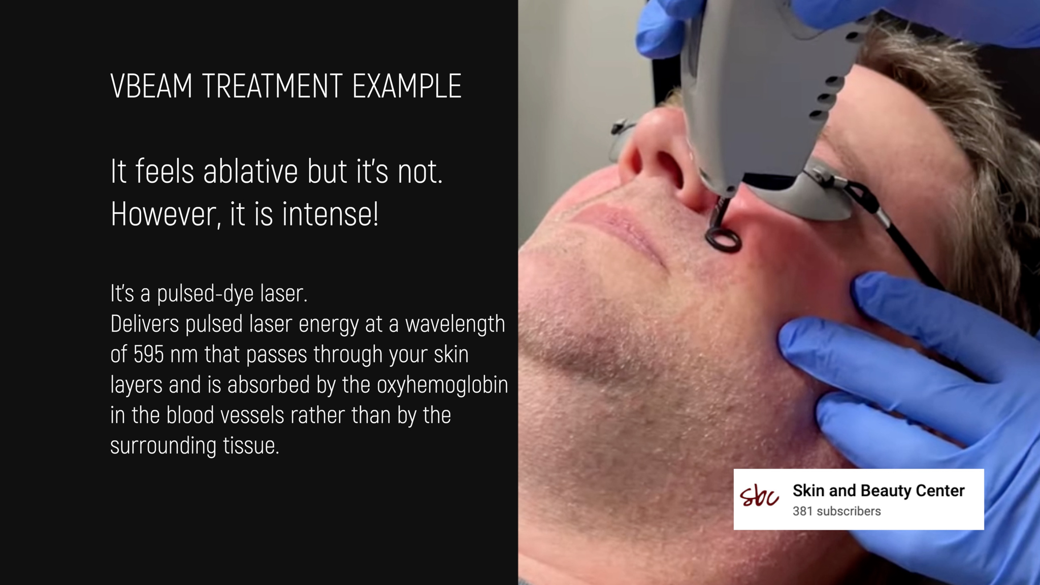 VBEAM LASER BEFORE AND AFTER - treatment image