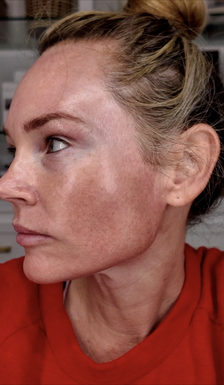 TCA PEEL EVERYTHING YOU NEED TO KNOW - treatment image