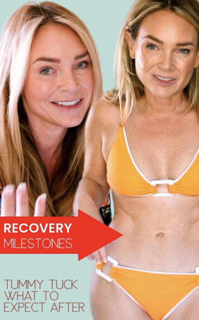 What to Expect After Tummy Tuck Surgery Recovery Milestones by DAY