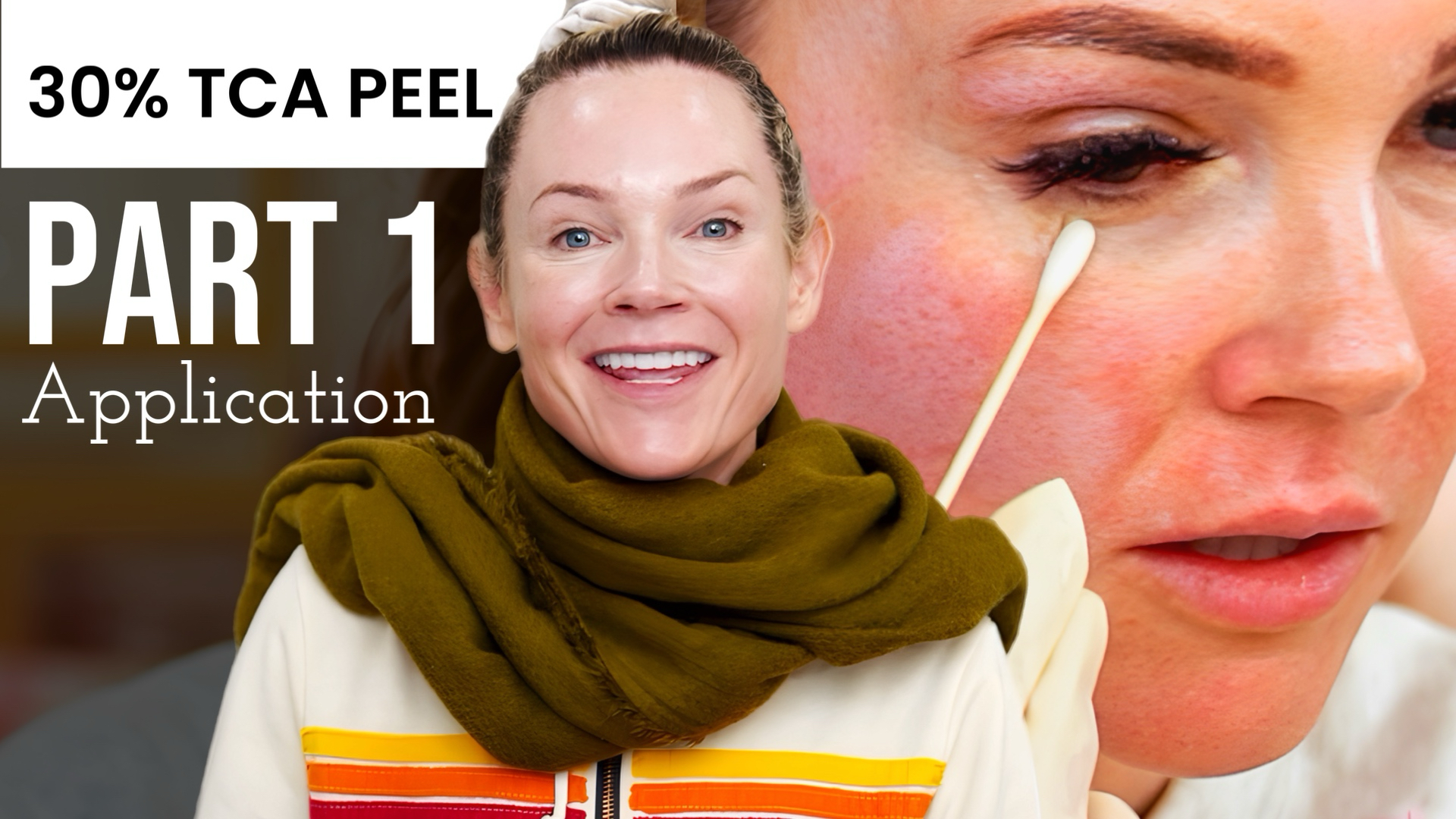 30% TCA PEEL PART 1 – APPLICATION