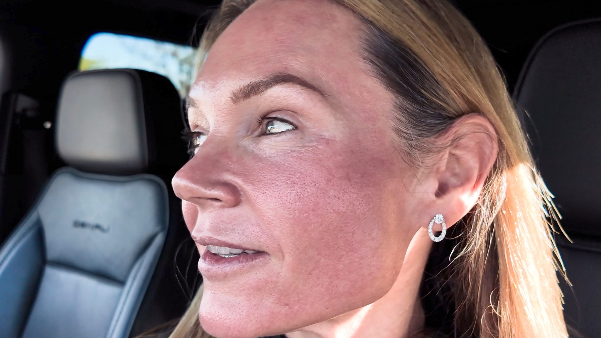 VBEAM LASER BEFORE AND AFTER - treatment image