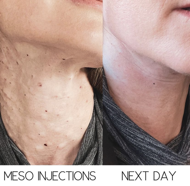 MESOTHERAPY - treatment image