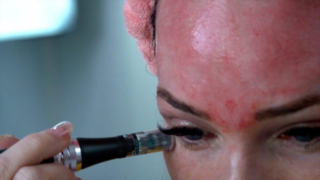 Microneedling with Derma-E Serum! Plus Sheet Mask Tip