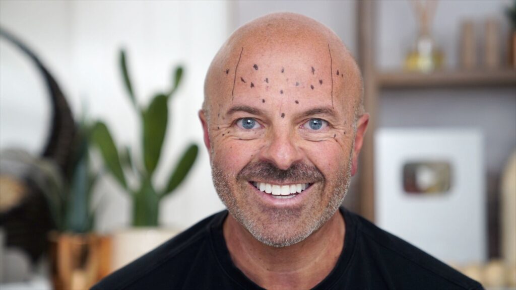Brotox Breakdown: What You Need to Know About Botox for Guys