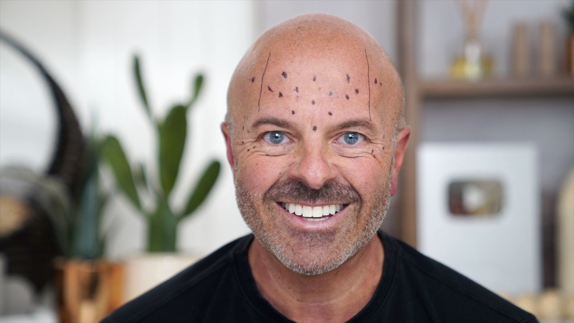 Brotox Breakdown: What You Need to Know About Botox for Guys