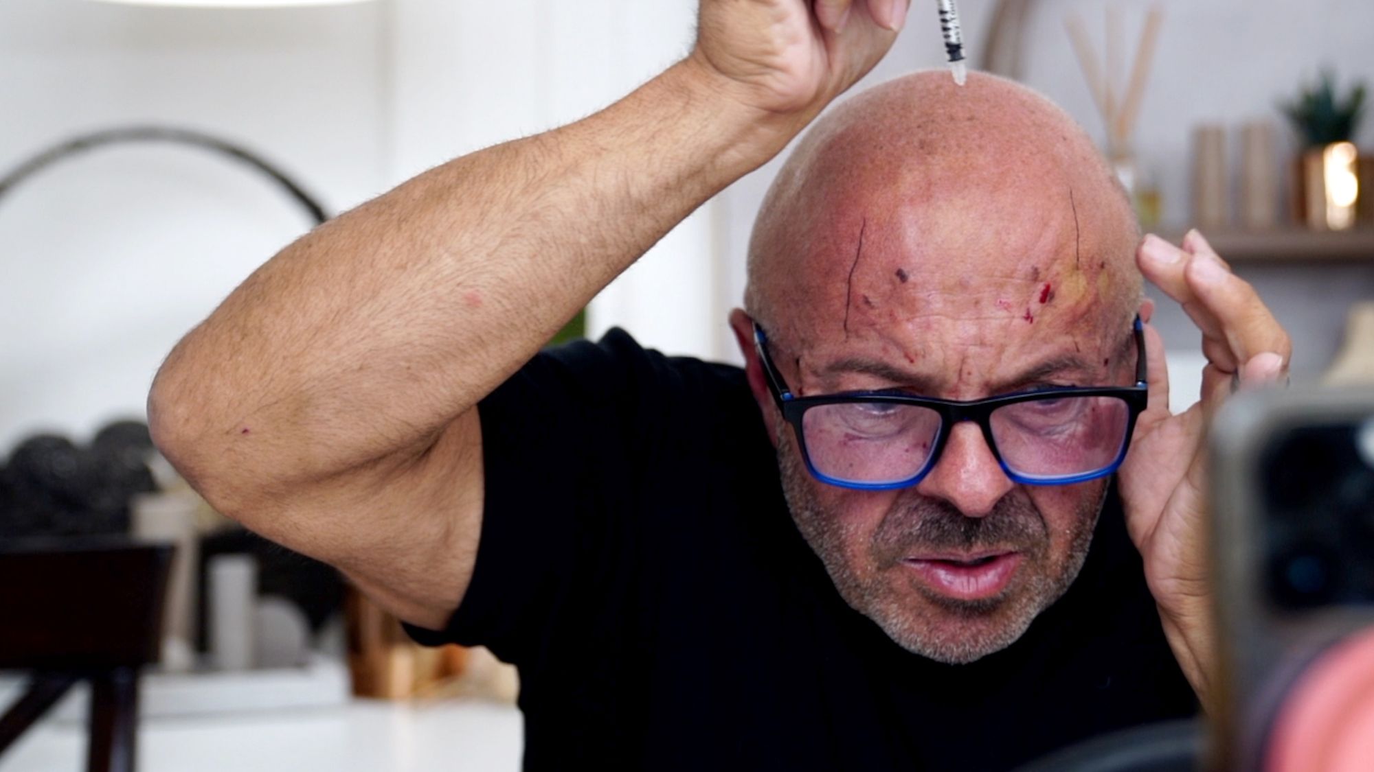 Brotox Breakdown: What You Need to Know About Botox for Guys - treatment image