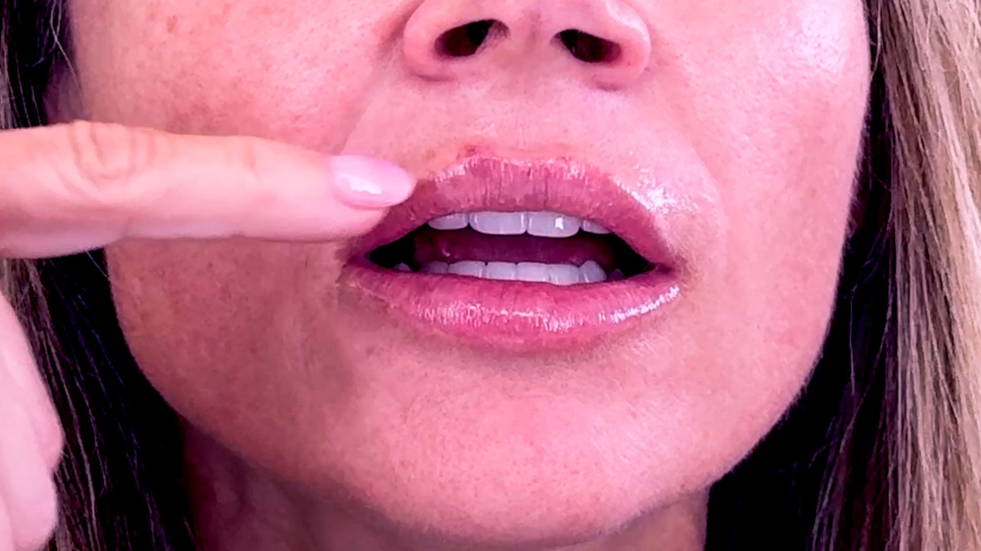 Restylane Kysse Lip Filler: Why the Cannula Method is a Game Changer! - treatment image