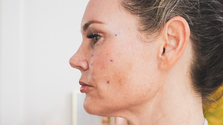 Gouri PCL and Hyafillia Lip Filler - treatment image